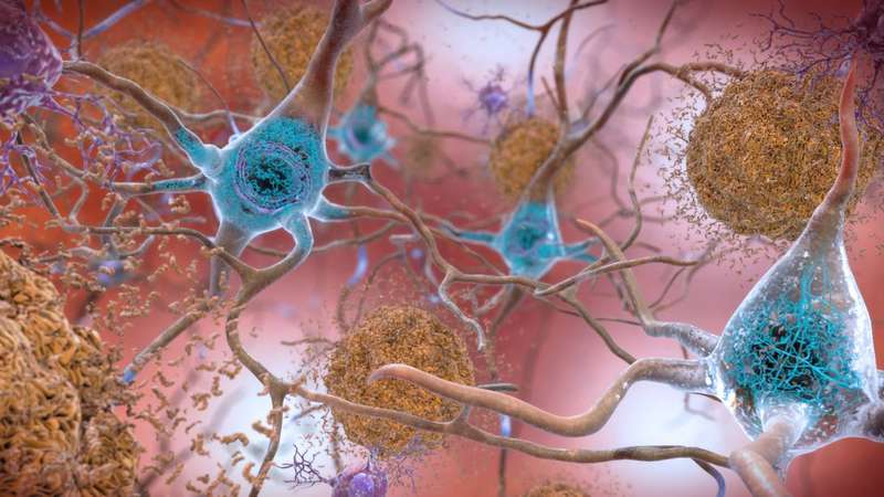 Illustration of beta-amyloid plaques and tau tangles in the brain