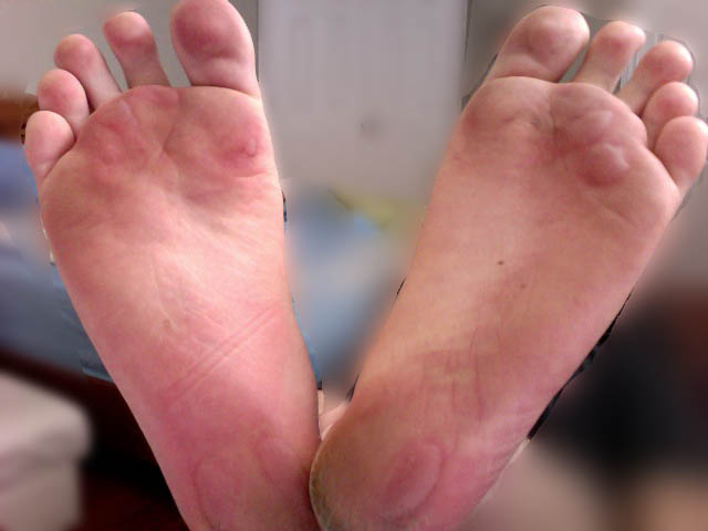 Friction blisters on a human foot