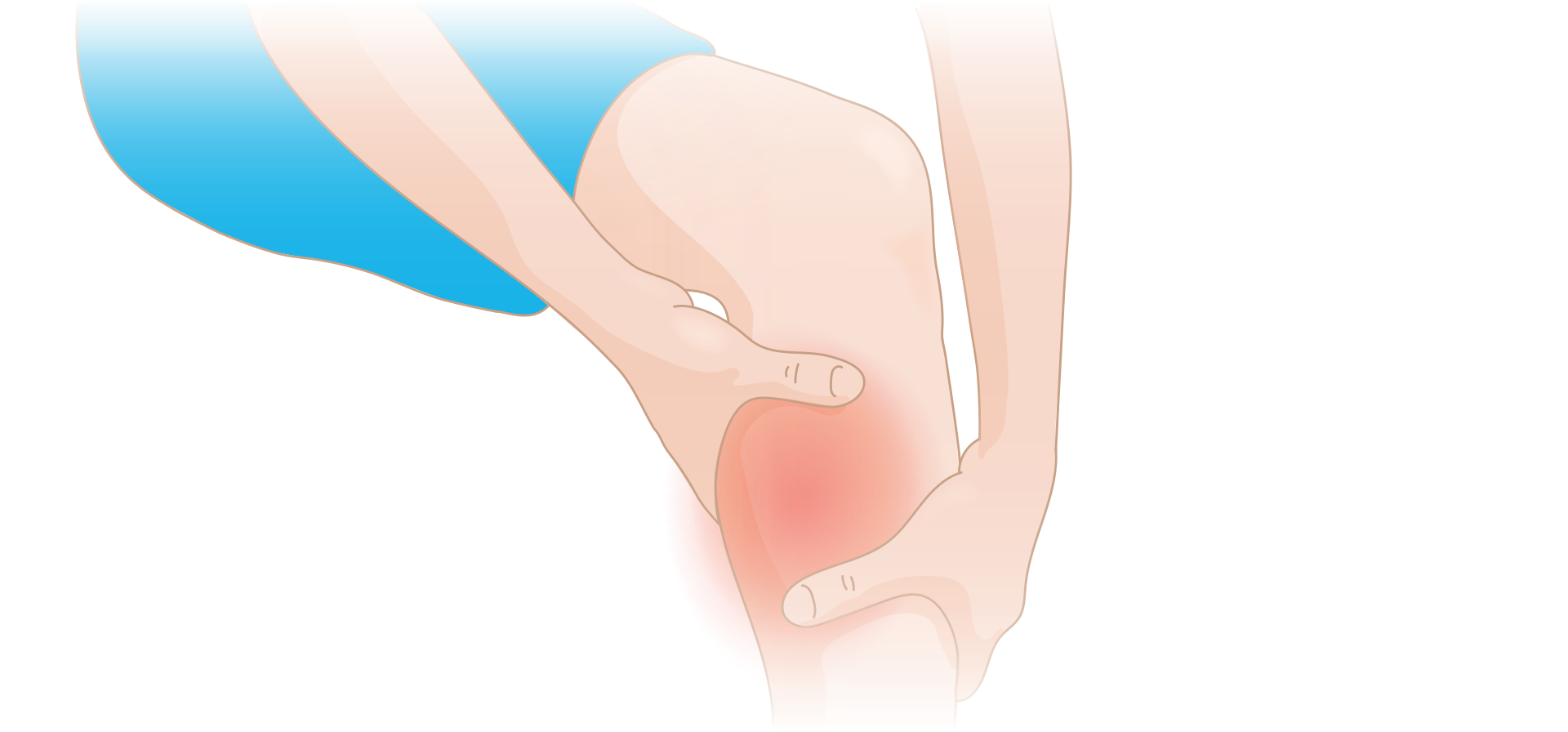 Illustration of a person gripping their calf, with the painful area highlighted in red