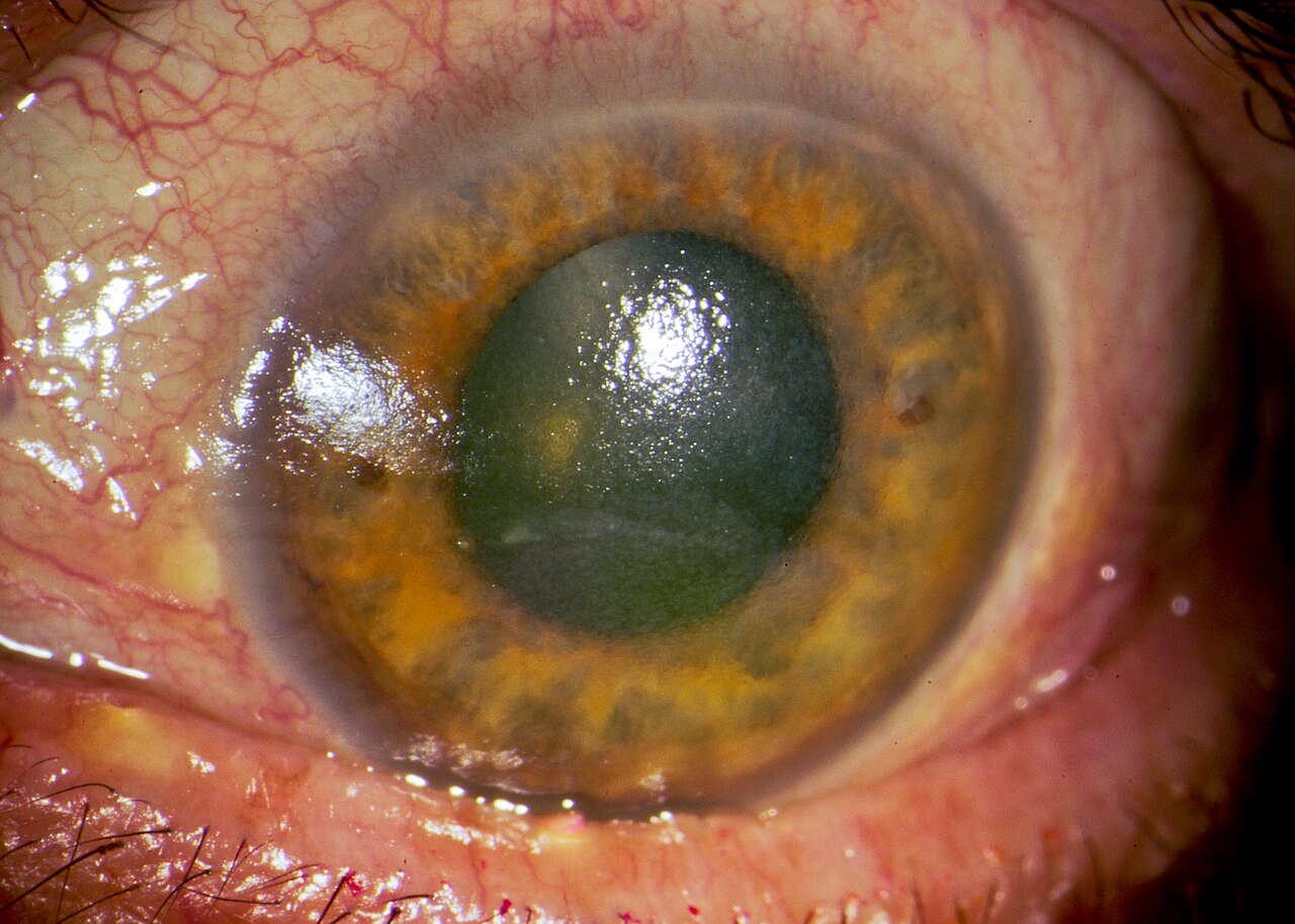 A clinical view of dry eye, where the tear film fails to protect the eye surface