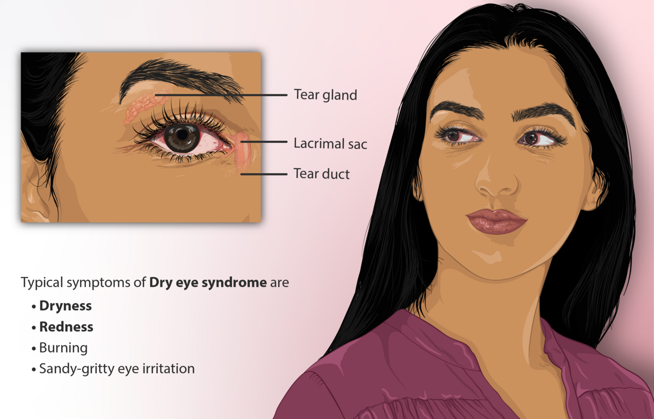 An illustration of dry eye symptoms, including the gritty, irritated feeling many people notice on waking