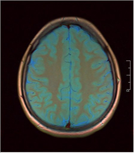 An MRI scan showing a cross-section of the human brain