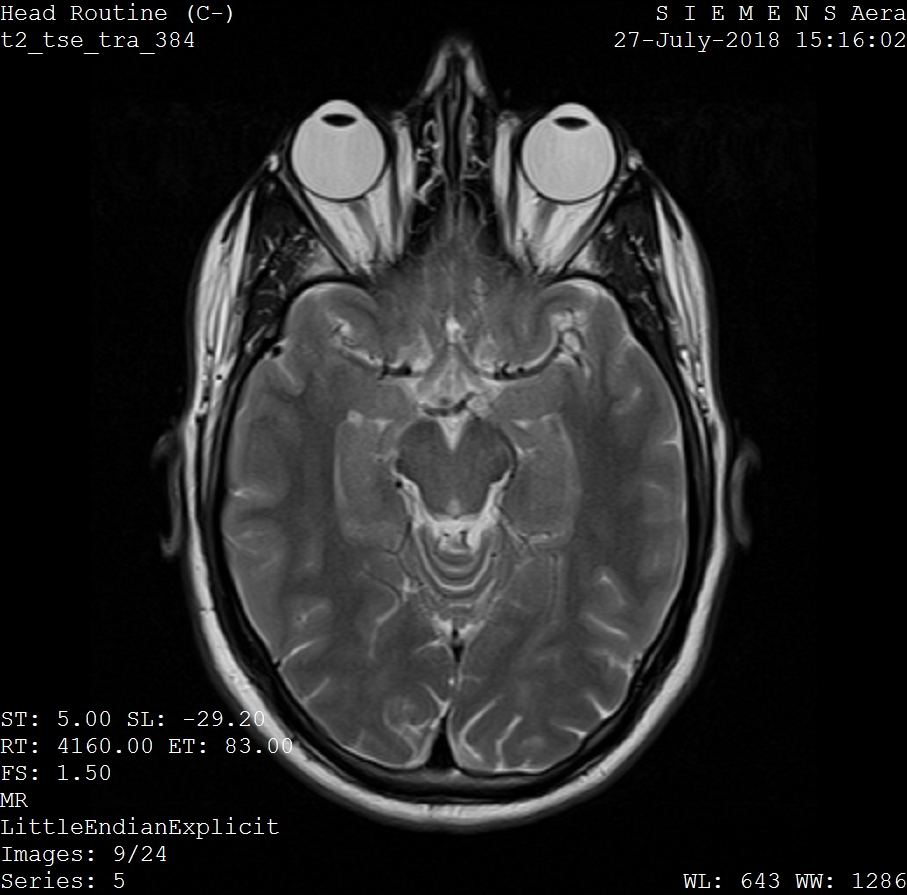 A general illustration of an MRI brain scan