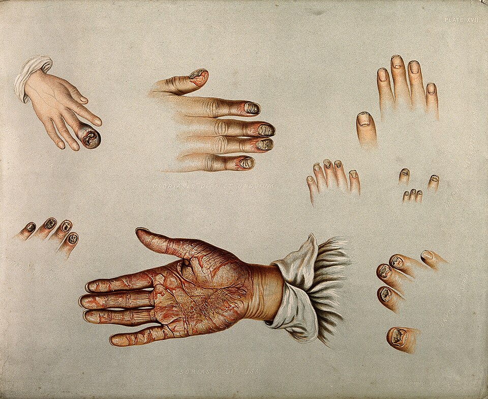 A 19th-century illustration of skin and nail conditions