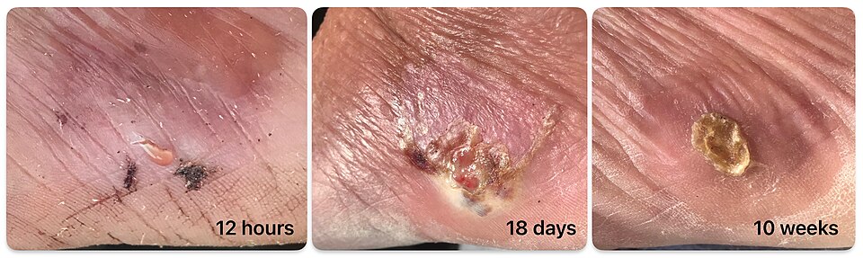 A stingray wound healing over ten weeks