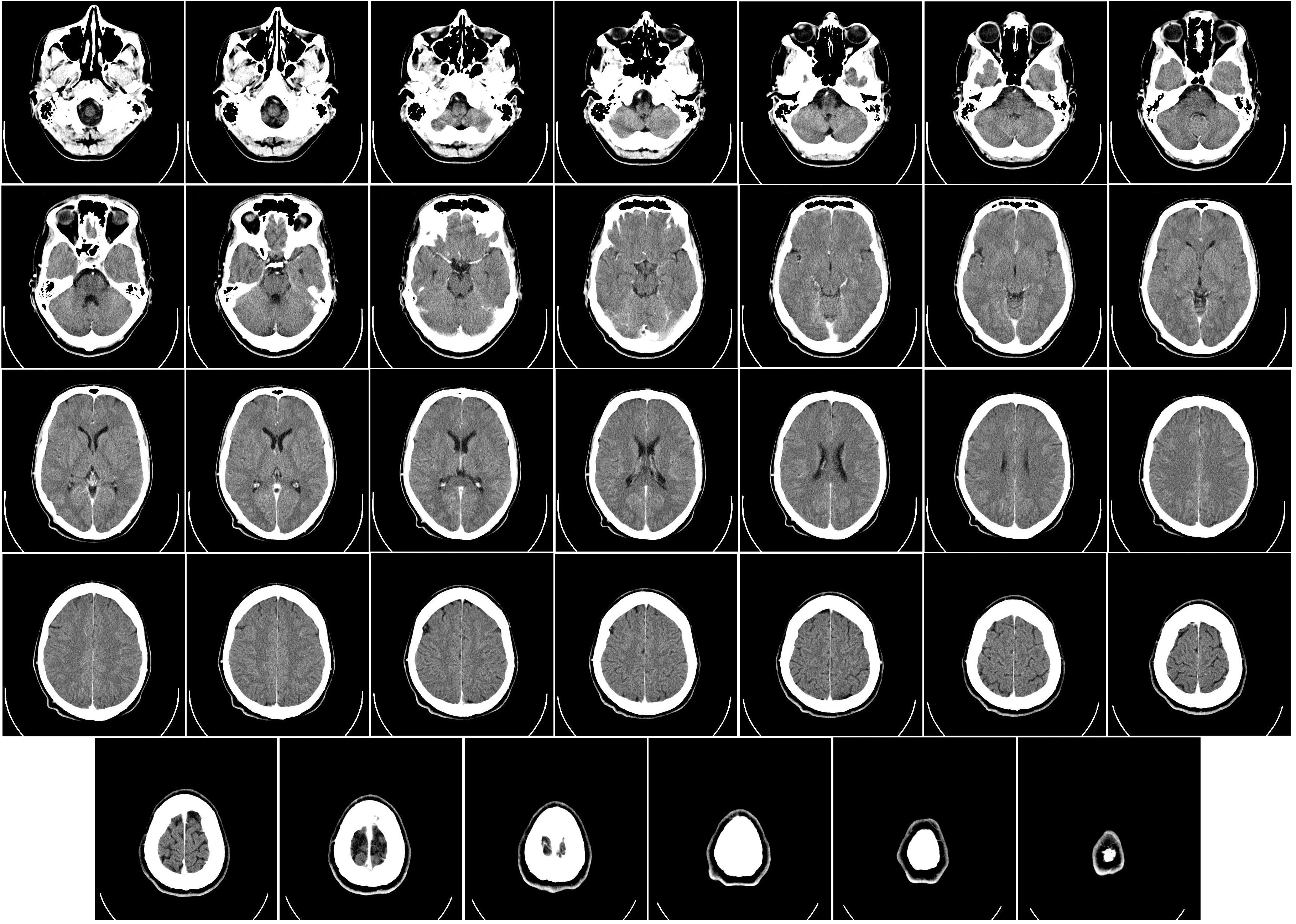 A CT scan of a human brain showing brain structure from above