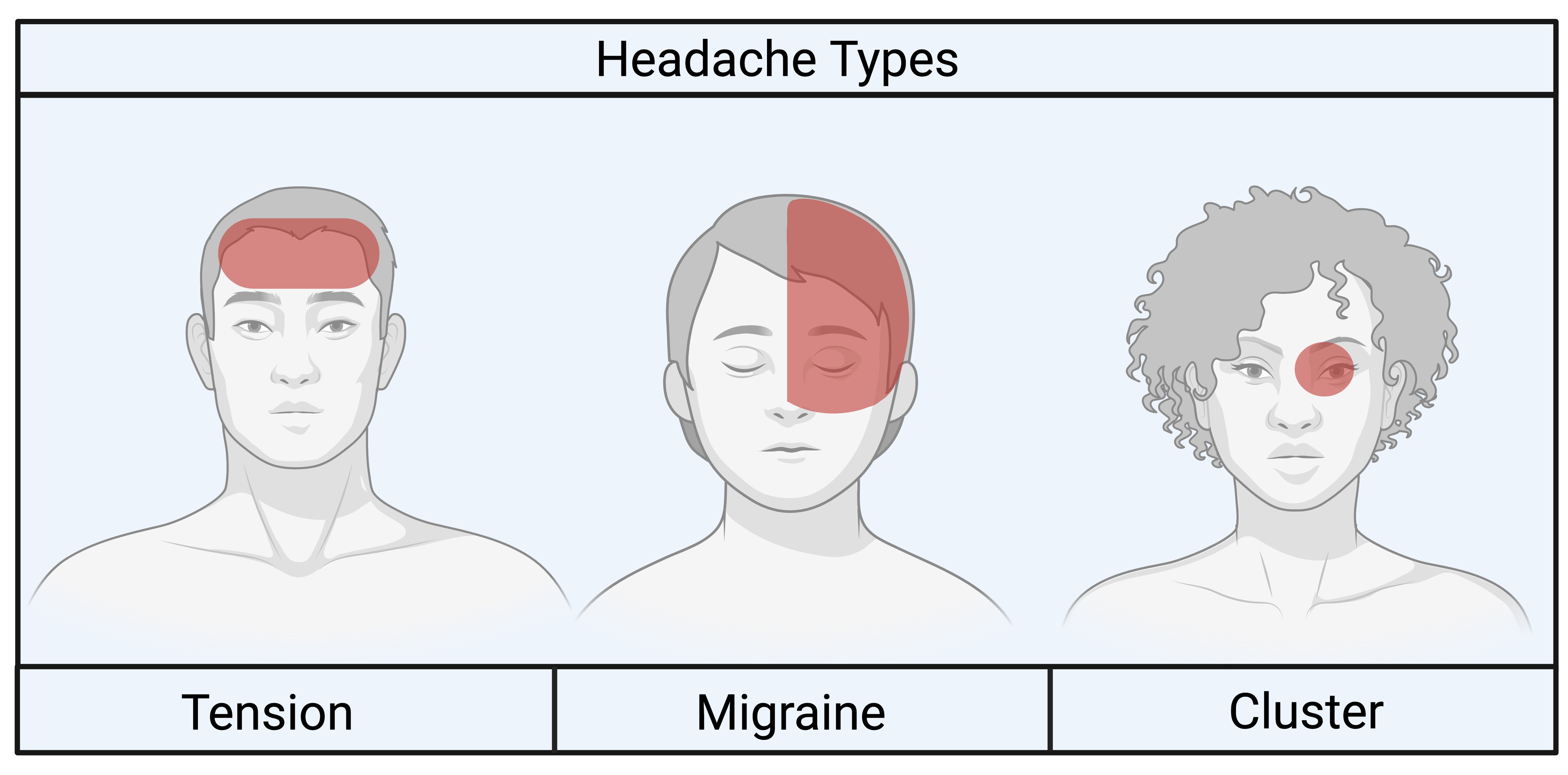 A diagram showing where different primary headache types are felt